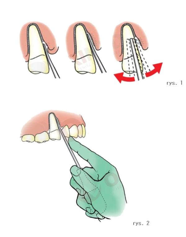 Narzędzie luksujące Perioluks 3+5 mm