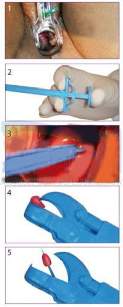 Kleszczyki do biopsji szyjki macicy, GYN&PUSH, jednorazowe, sterylne, 1szt. 